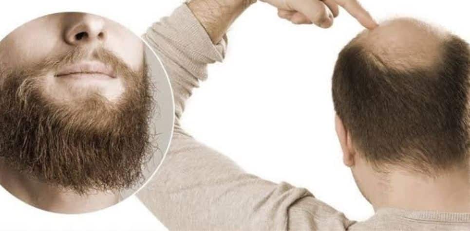 Before and Preparations for Beard Transplantation Operation